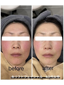 イル 名取店(iru)/糸式リフトアップフェイシャル