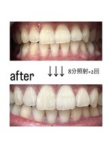 フラン(franc)/