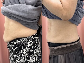 リメイクビューティークリニック(REMAKE BEAUTY CLINIC)/痩身！身体痩せ！脂肪撲滅！