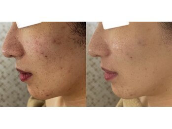 マスカレード 品川(Masquerade)/【症例写真】施術1回