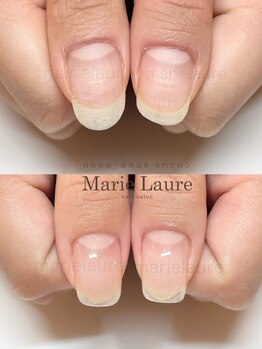 マリーロール 梅田店(Marie Laure)/深爪矯正/自爪育成/自爪風