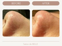 サロンドベル(Salon de BELLE)/ビフォー&アフター(毛穴洗浄)