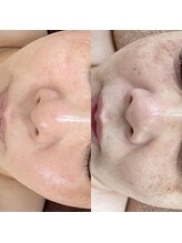 ウイユ(Oeil)/剥けるハーブピーリング効果３回