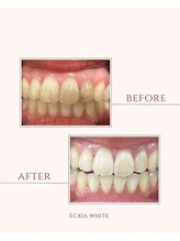 エクシアホワイトニング 秋田大町店/ビフォーアフター