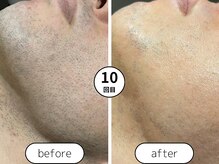 身だしなみラボ(MIDASHINAMILABO)/ヒゲ脱毛１０回ビフォーアフター