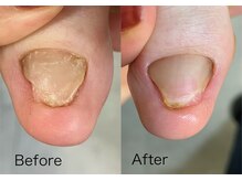 ロンディネ(Rondine)/トラブルネイル1106