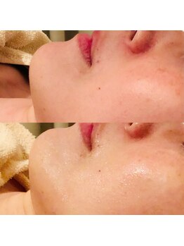 K.ステージ/スキピュールピーリング