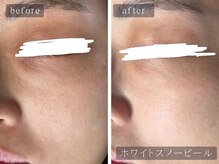 アムールサロン(Amour salon)/ホワイトスノーピール【新宿】