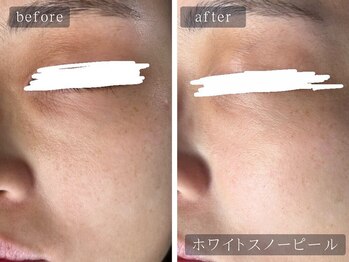 アムールサロン(Amour salon)/ホワイトスノーピール【新宿】