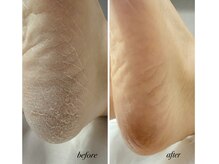 かたい足裏。ガサガサかかとをツルスベふっくら足へ♪