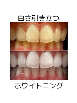 サリーサロン(SallySalon)/歯のセルフホワイトニング