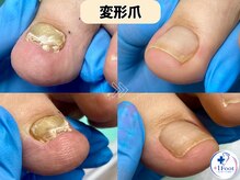 プラスワンフット 本厚木(+1 Foot)/伸びずに厚くなった足の親指の爪