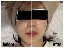 バブル(BUBRU)/光フェイシャル1回の施術変化