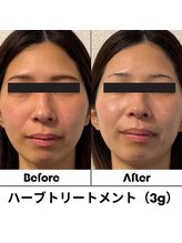 ルアナ 北谷店/ハーブピーリング 《沖縄/北谷》