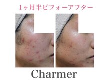 シャルメール 堀江(Charmer)の雰囲気（ニキビ改善が得意なサロン☆たくさんの症例写真がございます♪）