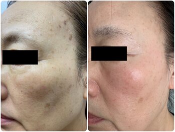 いおり骨盤整体 リブート(RE:BOOT)/ハーブピーリング