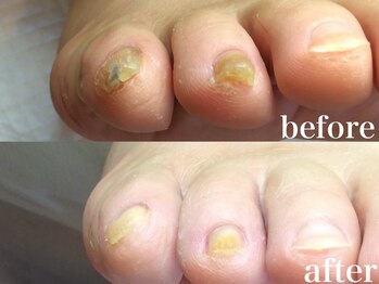 ドクターネイル爪革命 札幌本店/症例紹介 2 肥厚爪