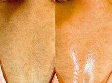 ミエリア美容鍼灸院(mielia美容鍼灸院)/鍼×導入で叶う背中美人