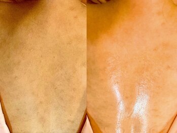 ミエリア美容鍼灸院(mielia美容鍼灸院)/鍼×導入で叶う背中美人