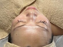チョクチョクサロン(CHOKCHOK. Salon)/美顔器使用した毛穴ケアも大人気