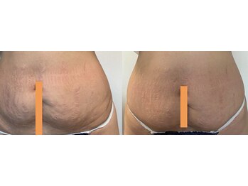 ソフィーム/妊娠線が薄くお腹もスッキリ