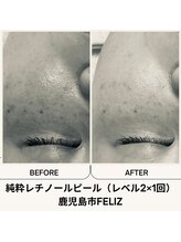 フェリス(FELIZ)/純粋レチノールピール