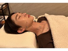 デルタエヌピー63+(δnp63+)/施術[薬院/小顔鍼/フェイシャル]