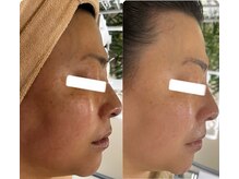 マスカレード 品川(Masquerade)/【症例写真】施術1回