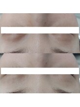 ヴェルシック(Belchic)/瞼の上まで施術が可能