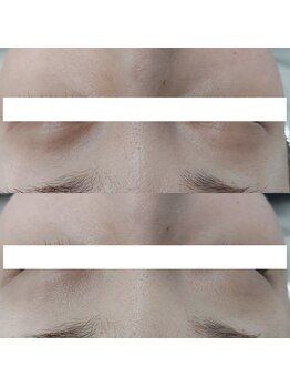 ヴェルシック(Belchic)/瞼の上まで施術が可能