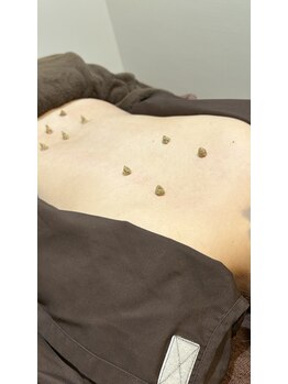 鍼灸ハウス(鍼灸house)/本格お灸