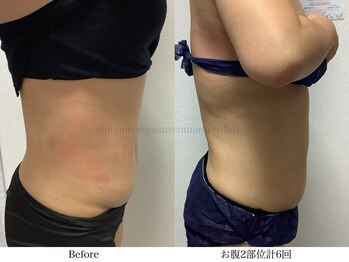 スラリ(SLARI)/【腹部　脂肪冷却】期間1か月半