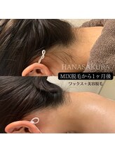 ハナサクラ 心斎橋(HANASAKURA)/ワックスと美容脱毛を併用すると