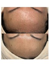 エネイブル(ENable)/プラズマニアで肌が変わる！！