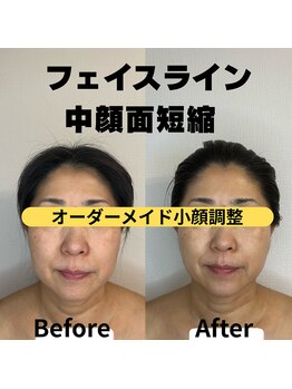 リル(LIL)の写真/【初回で効果を実感】表面だけでなく内側から引き上げでたるみ改善◎若々しい印象のお顔に導きます！