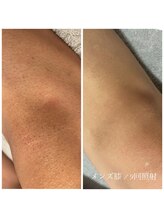 エクラ(eclat)/メンズ足脱毛