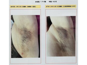 ソレイユ/ワキ脱毛☆体験1000円