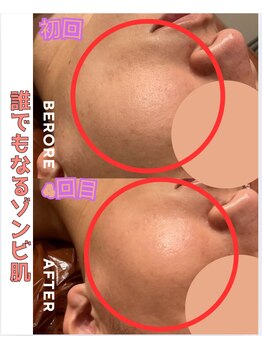 パルティノ 高崎店/20代・ほほのごわつき悩み