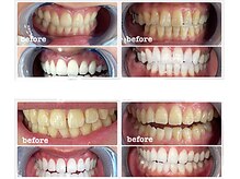 ミース 自由が丘店(MYS)/ビフォーアフターホワイトニング