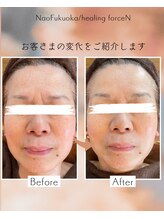 ナオフクオカ ヒーリングフォースエヌ(NaoFukuoka/healingforceN)/ヒト幹細胞で錆びない肌育を！