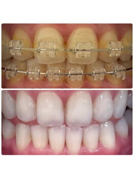 サリーサロン(SallySalon)/矯正中でもホワイトニングOK