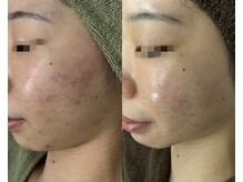 肌質改善専門【Salon da Mahina】毛穴ケア/ニキビケア/ハーブピーリング/ニキビ/毛穴/ハーブピーリング