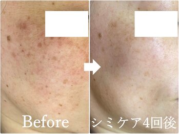 ニコ アンド キャンディー(Nico.&Candy)/本気でシミ改善したい方募集中