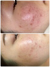 リボディ プラチナ(Rebody platinum)/プラズマ/プラズマシャイニー