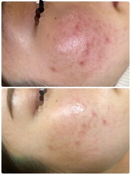 リボディ プラチナ(Rebody platinum)/プラズマ/プラズマシャイニー