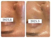 サロン ド エメ(salon de aimer)/ぽっかり開いた毛穴根本改善へ