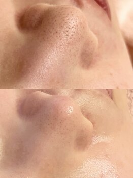 リンダ 西宮店(LINDA)の写真/毛穴悩みに終止符！毛穴洗浄&肌質改善ハーブピーリングで目指す、憧れの陶器肌へ☆