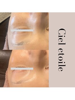 シエルエトワレ/CIVASAN シルク肌コース