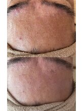 リジュベネ(rejuvena)/ハーブピーリング症例