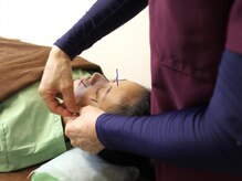 いなほ はりきゅう整骨院 東新宿/美容鍼施術/手順2